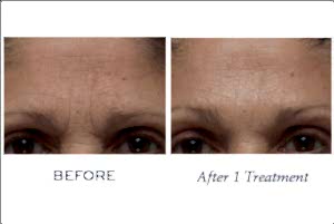 Biotec BAs 840x840Firm a Lift After 1 Treatment Forehead 2